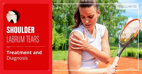 shoulder tear labrum treatment